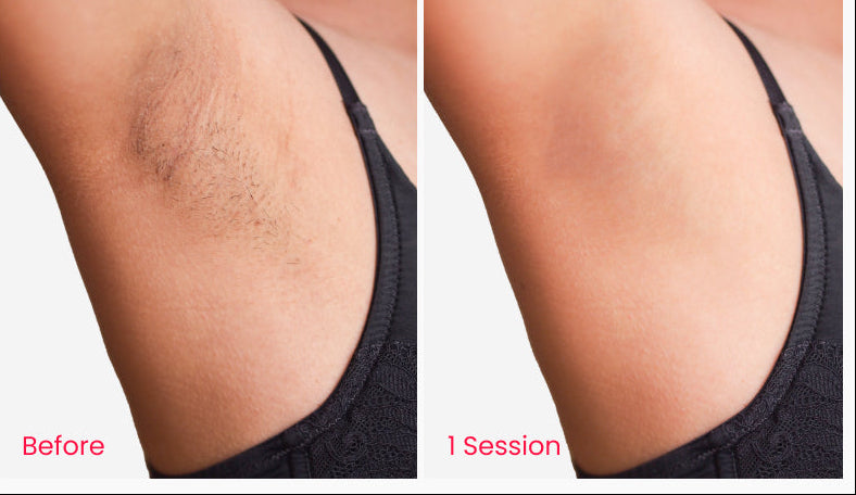 Hair Removal Device – Sapphire Ice Cooling Laser System for Fast, Painless Permanent Hair Reduction at Home