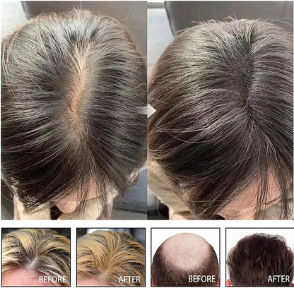 Hair Growth Serum– Anti Hair Loss Essence Treatment for Stronger Fuller Hair Growth in Men and Women